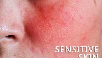 皮膚敏感紅腫可以怎樣解決?